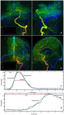 Peri-therapeutic multi-modal hemodynamic assessment and detection of predictors for symptomatic in-stent restenosis after percutaneous transluminal angioplasty and stenting